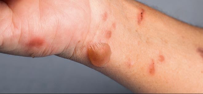 ভারতে টমেটো ফ্লু রোগে শতাধিক শিশু আক্রান্ত