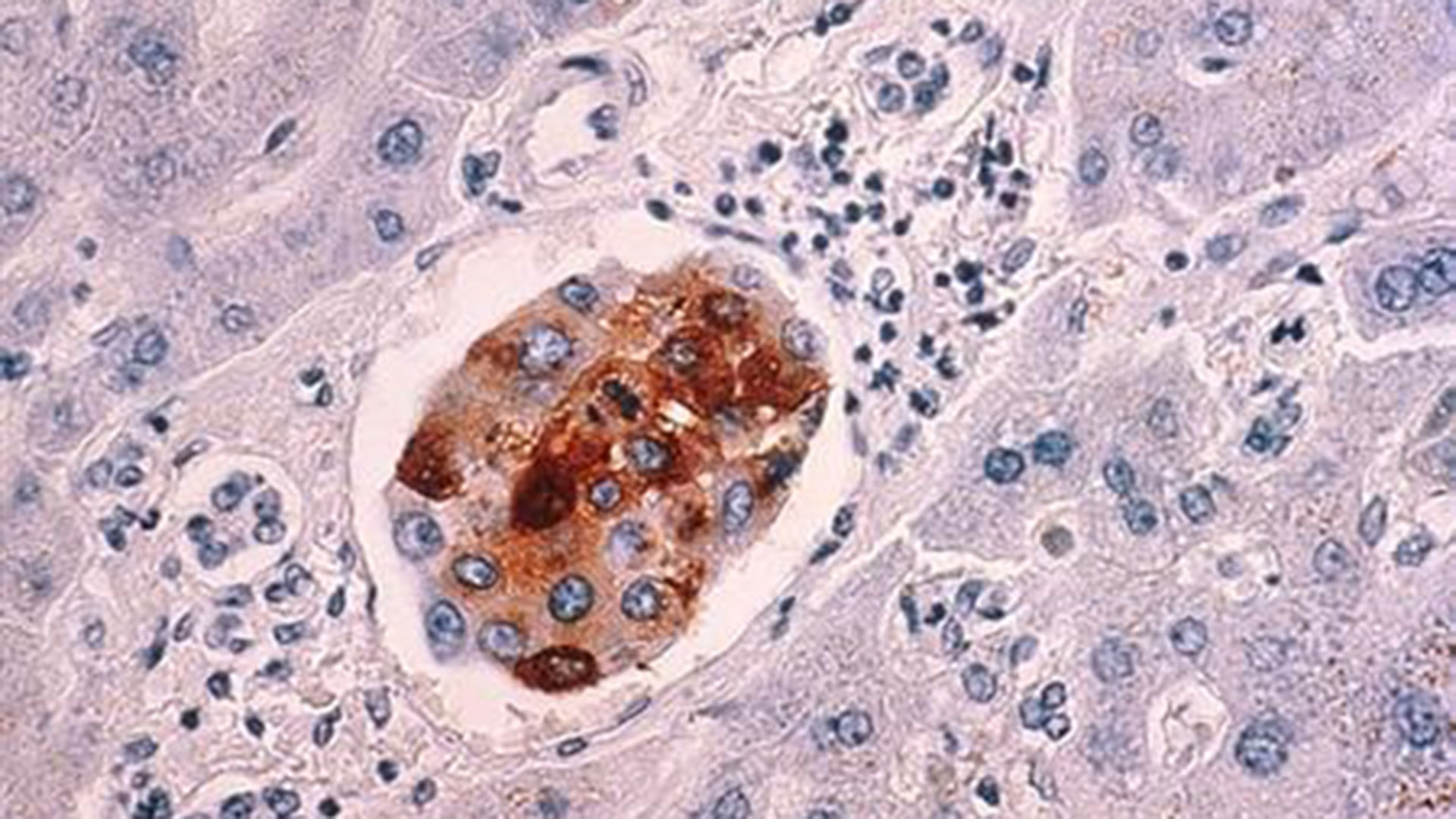 পুরুষের ফুসফুস, নারীর স্তন ক্যানসার বেশি