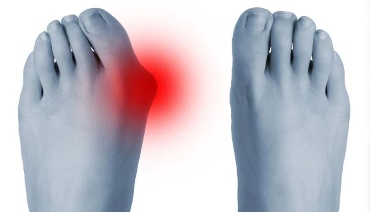 ইউরিক অ্যাসিড বাড়লে কী করবেন