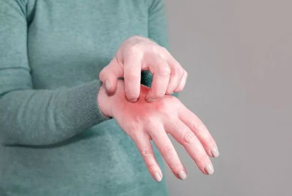 স্ক্যাবিস বা খোসপাঁচড়া হলে কী করবেন, প্রতিরোধে করণীয়