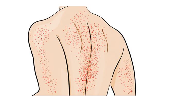 রক্তরোগ ইমিউন থ্রম্বোসাইটোপেনিয়া বা আইটিপি নিয়ে যা জানা প্রয়োজন