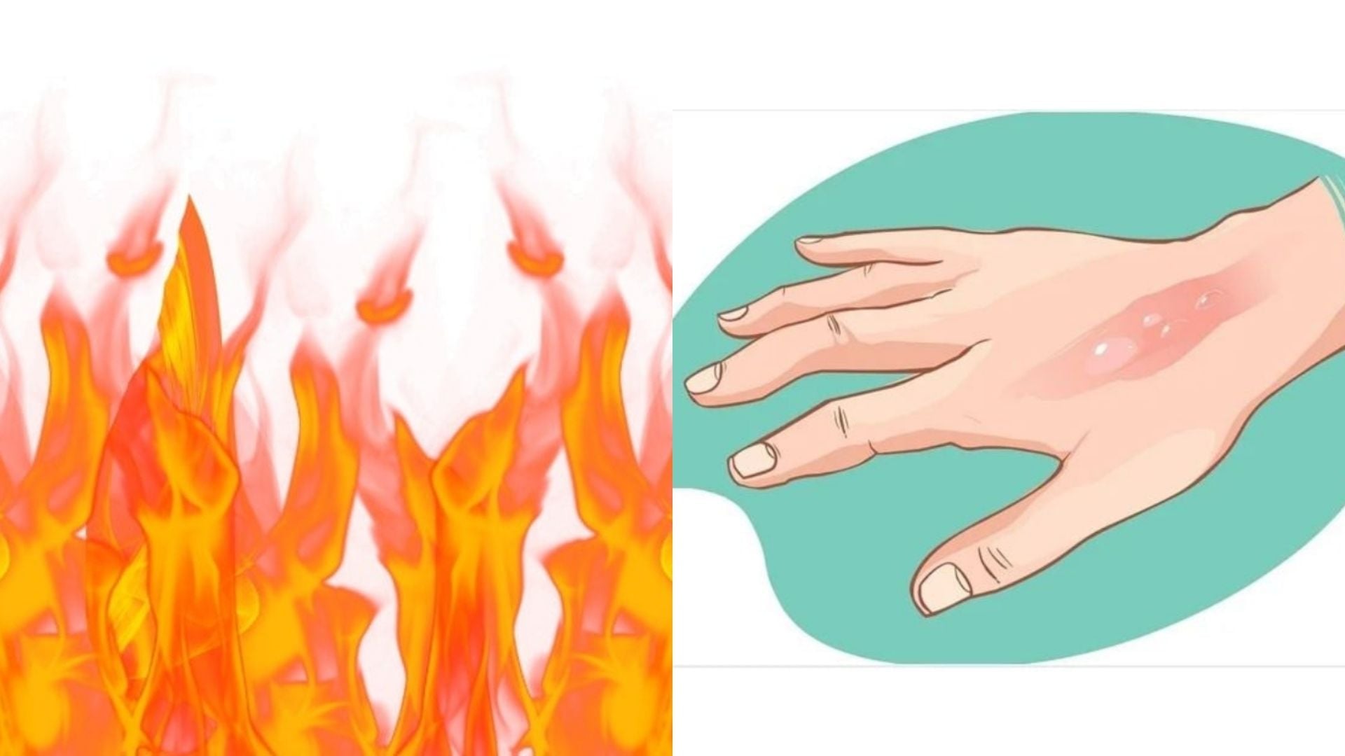 আগুন বা গরম জিনিসে ত্বক পুড়ে গেলে করণীয় কী