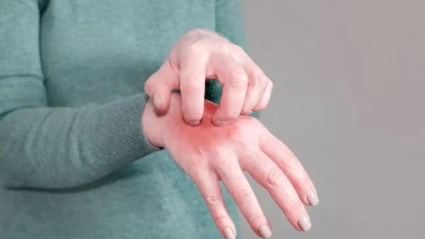 স্ক্যাবিস বা খোসপাঁচড়া 